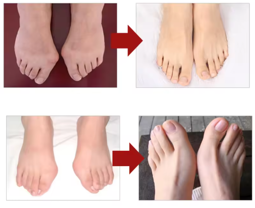 CORRECTOR DE JUANETE X6UNDS - POC-119